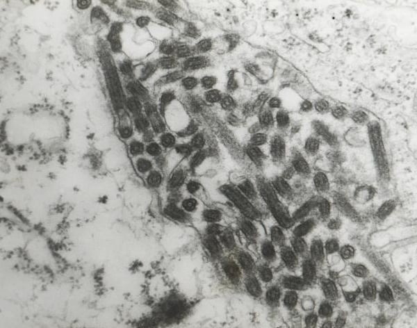 Transmission electron microscopic image confirming Marburg virus in a hemorrhagic fever patient