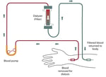Medical illustration showing hemodialysis treatment for patients with kidney failure
