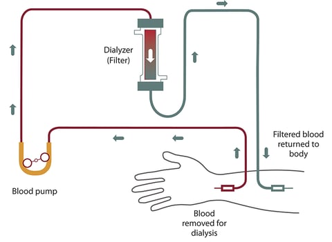 Medical illustration showing hemodialysis treatment for patients with kidney failure