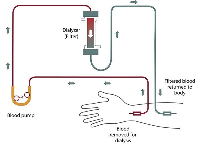Medical illustration showing hemodialysis treatment for patients with kidney failure