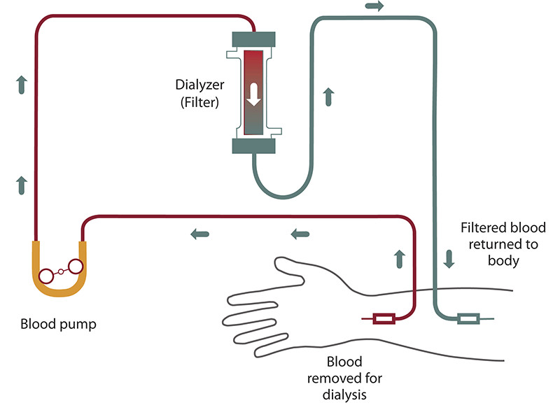 Medical illustration showing hemodialysis treatment for patients with kidney failure