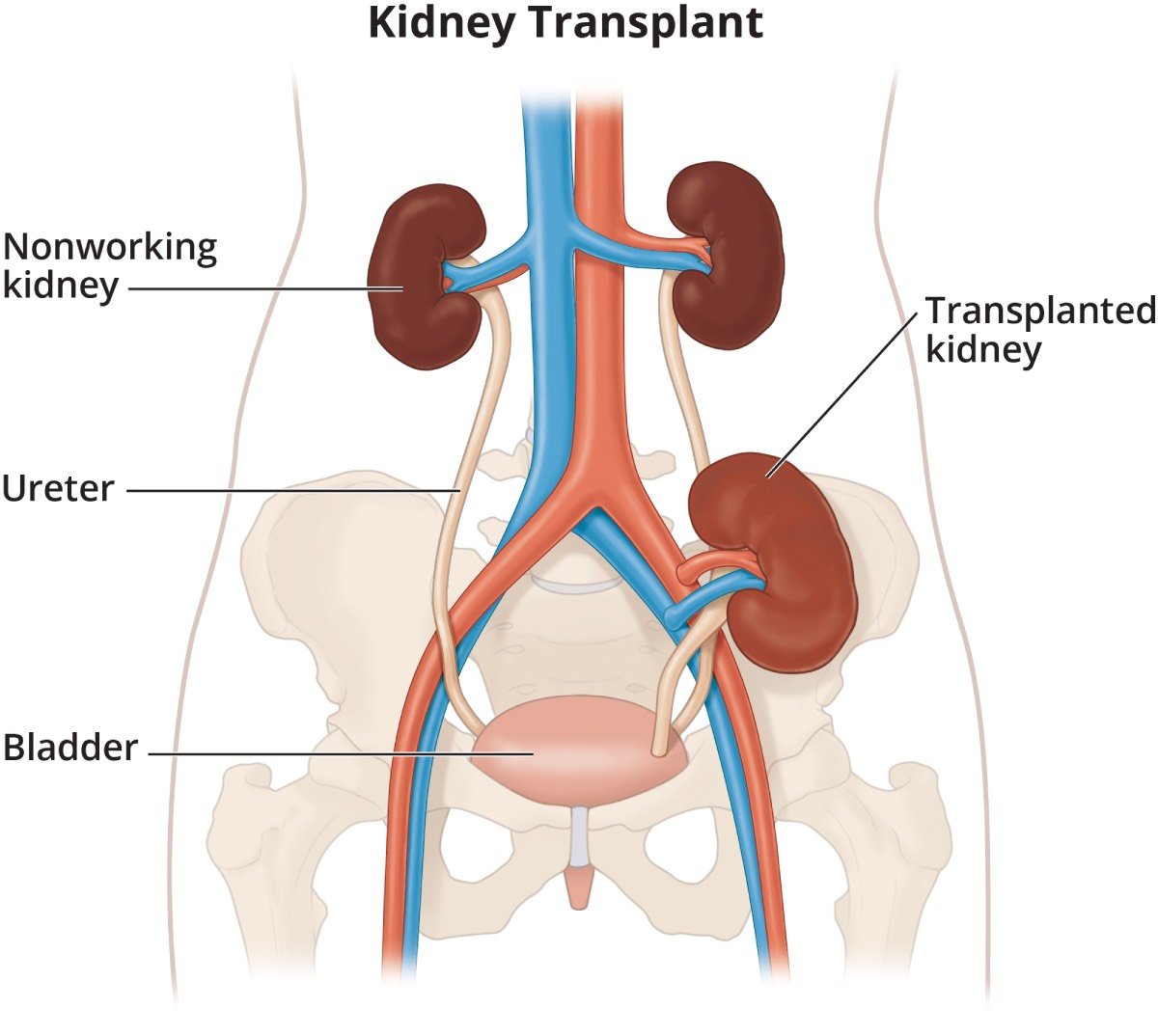 Anatomical diagram showing kidney transplant surgery with donor kidney placement in recipient