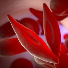 Illustration showing sickle-shaped red blood cells that block blood vessels in sickle cell disease
