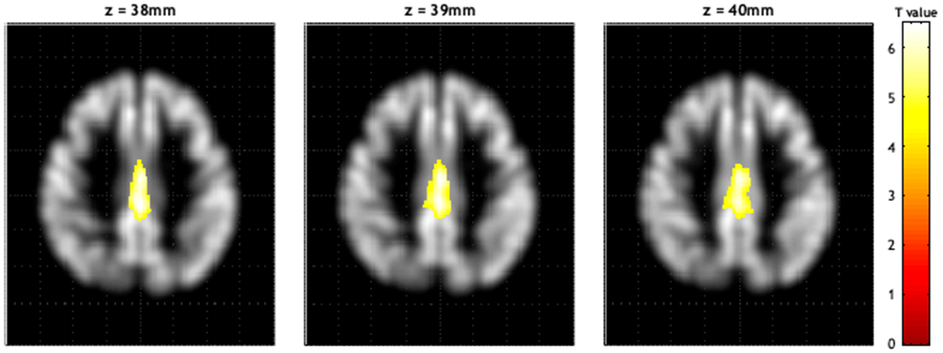 Brain MRI voxel-wise correlation map showing regions where vitamin C levels associate with gray matter volume in older adults
