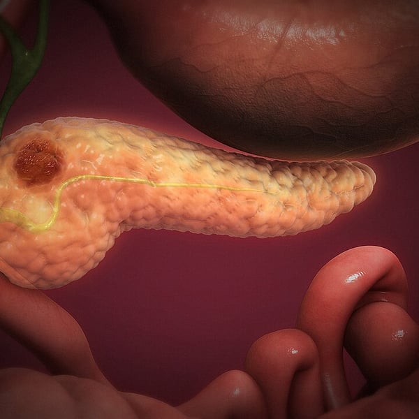 3D medical illustration showing pancreatic cancer tumor in the pancreas