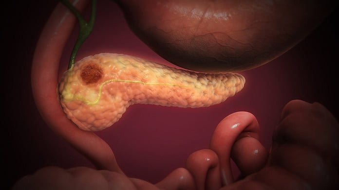 3D medical illustration showing pancreatic cancer tumor in the pancreas