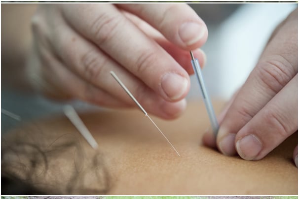 occupuncture-spinal-stenosis