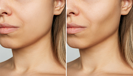 Buccal Fat Removal Buccal Fat Removal