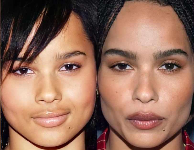 Zoe Kravitz after plastic surgery zoe kravitz plastic surgery