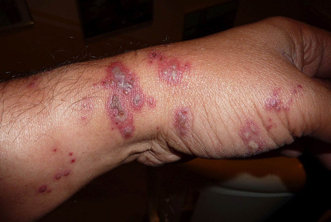 plague, health, pneumonic, travelers, arizona, bubonic, death, medical