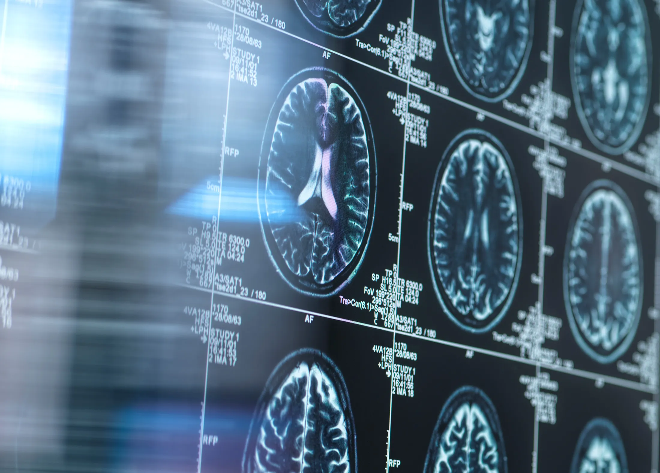 Roche pharmaceutical building, Alzheimer’s disease, brain scan, experimental drug, blood-brain barrier, trontinemab, brain shuttle technology, clinical trial