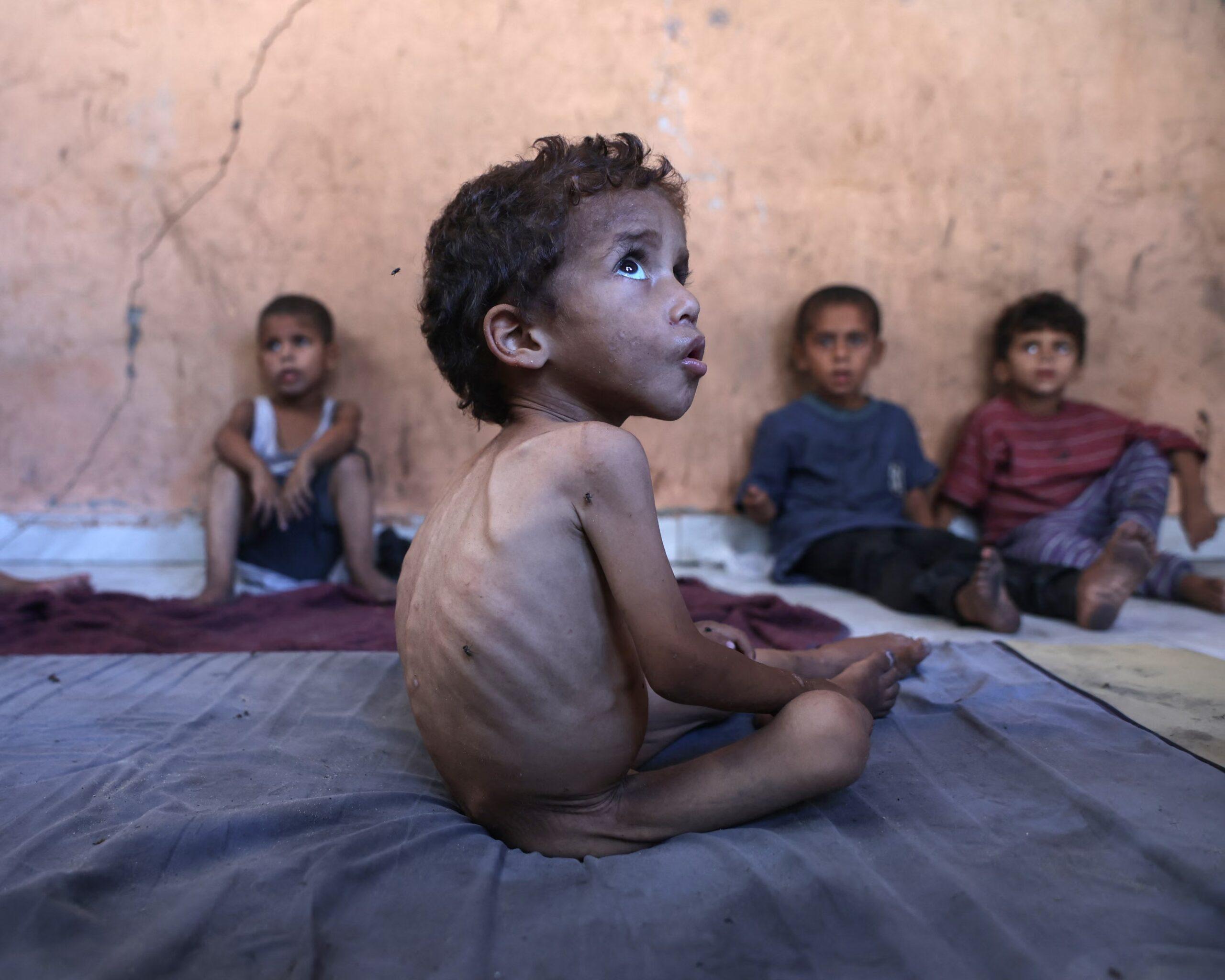 Gaza children malnourished, MSF famine Gaza, Israel blockade, Palestine starvation, humanitarian crisis