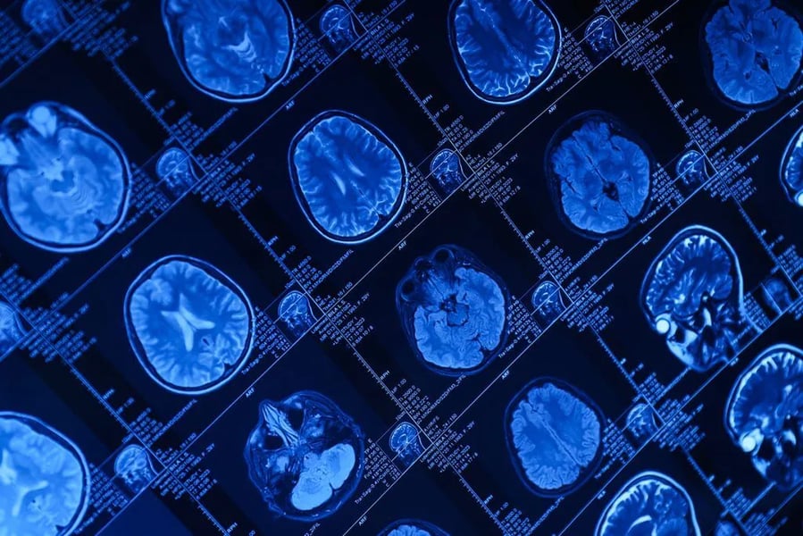 Huntington’s disease gene therapy AMT-130 delivered by MRI-guided neurosurgery at UCLH