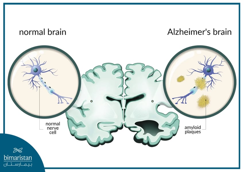 Alzheimer’s brain scan showing amyloid plaques and neurodegeneration