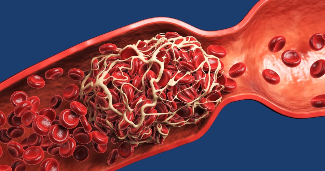 Medical illustration showing COVID-19 blood clot formation inside human blood vessels due to endothelial damage and vascular inflammation.