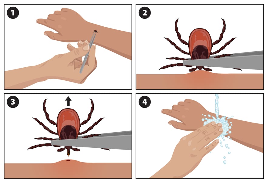 Fine-tipped tweezers removing an attached tick from skin using correct technique
