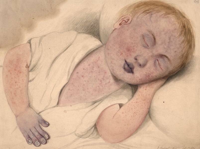 Historical photograph of a child with severe measles, the disease responsible for 2,104 US cases in 2026