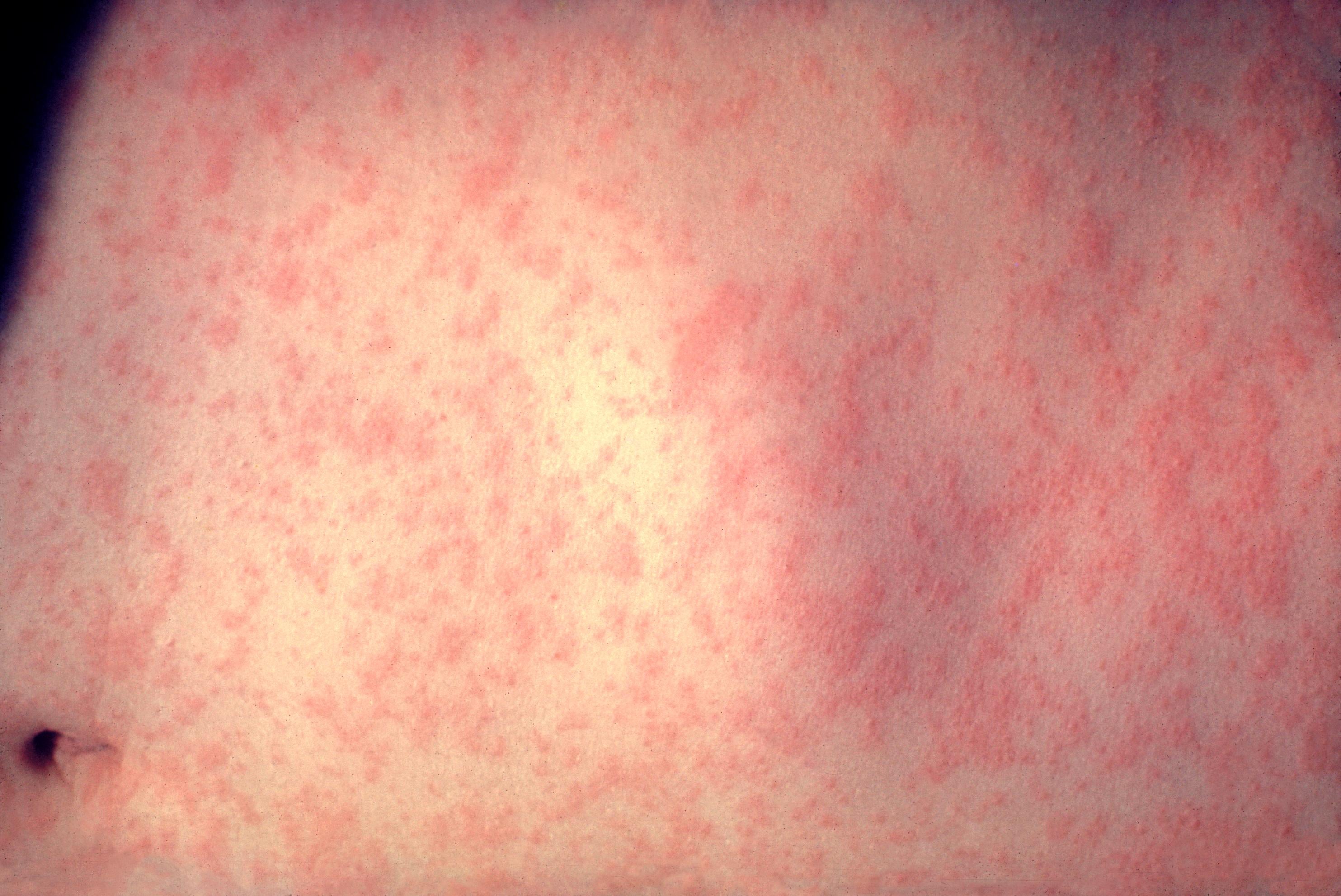 Morbillivirus measles infection microscopy image — 2026 US measles outbreak has confirmed 2,104 cases