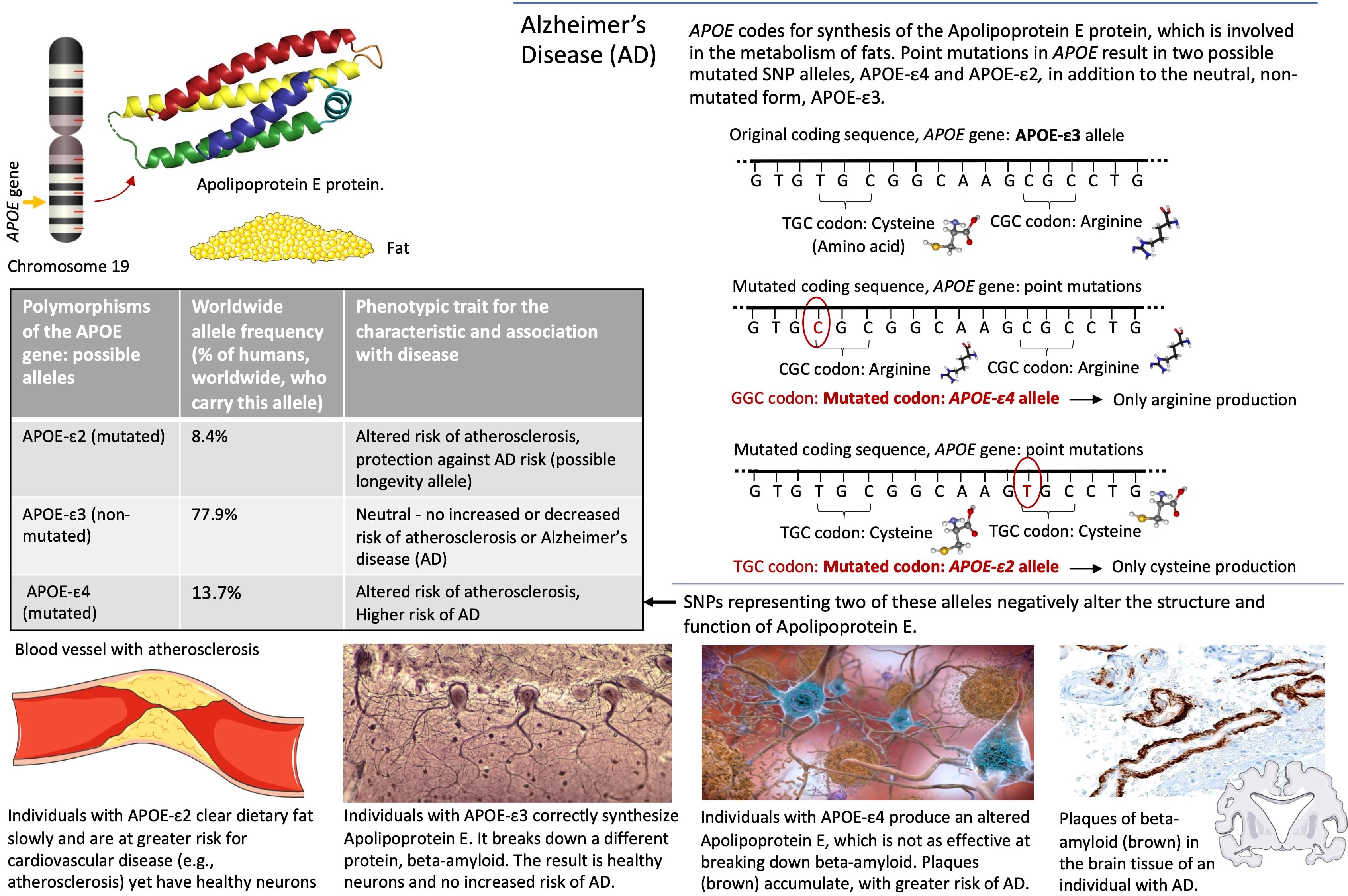 Infographic of Alzheimer's disease showing amyloid plaques, tau tangles, APOE protein, and comparison of healthy versus diseased neurons