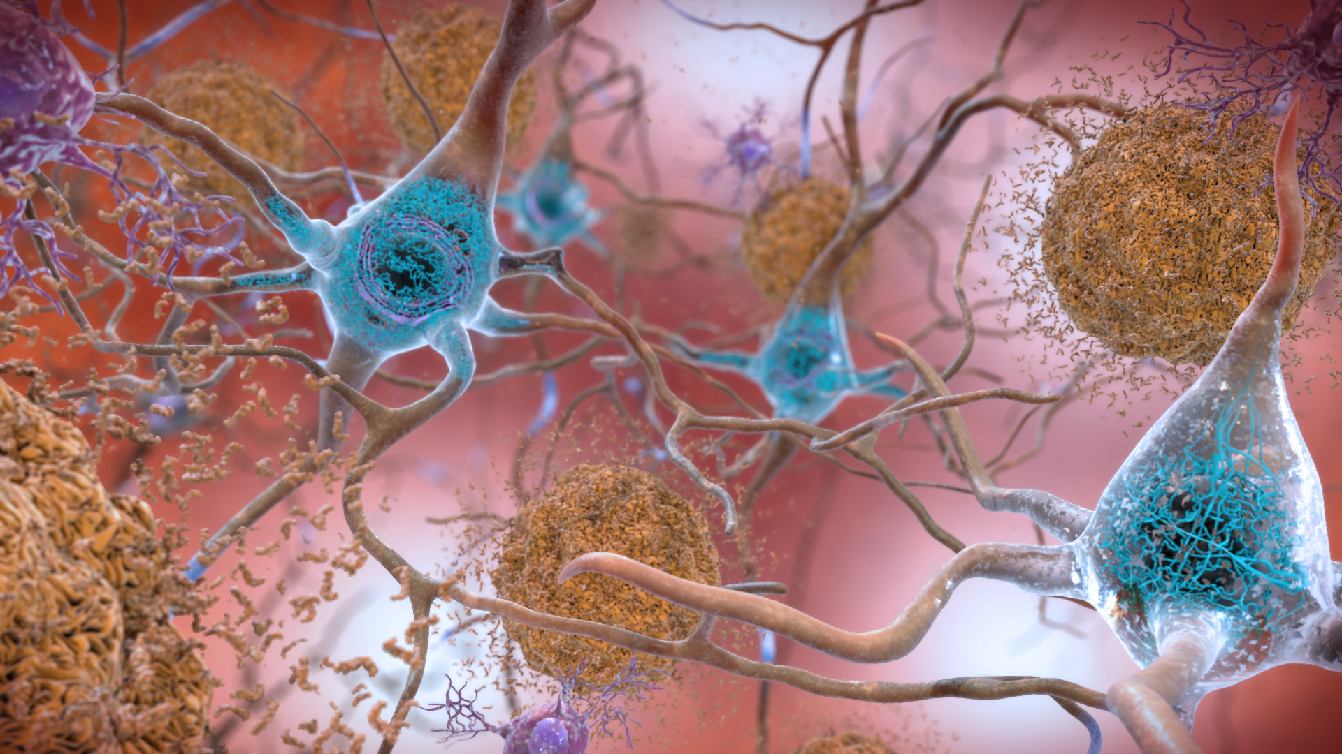 Illustration showing brown amyloid plaques between neurons and blue tau tangles inside neurons in Alzheimer's disease