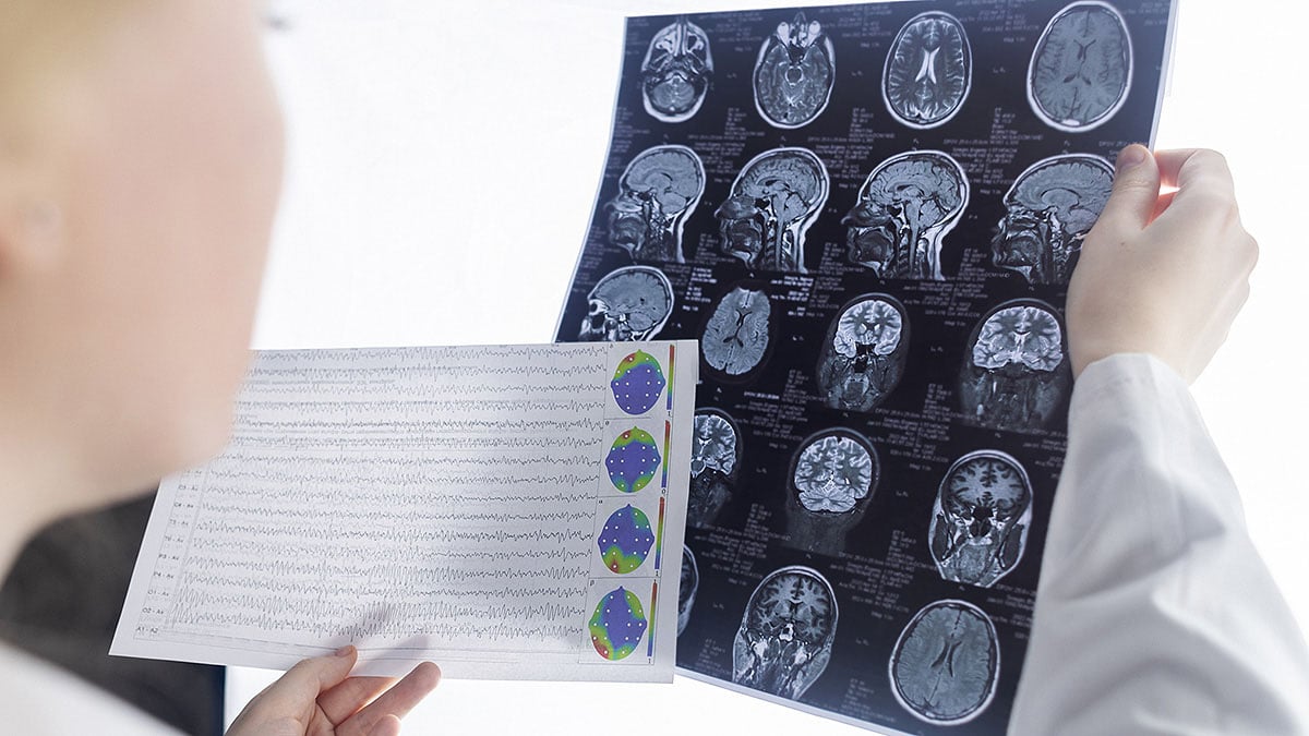 A physician reviews brain scan images in a clinical setting for epilepsy diagnosis