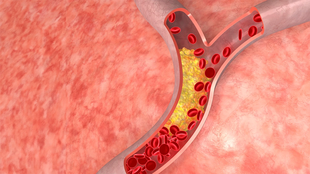 Illustration of cholesterol plaque buildup in blood vessels representing cardiovascular disease risk