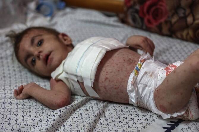 Displaced Palestinian families in Gaza tent camp amid chickenpox and disease outbreak