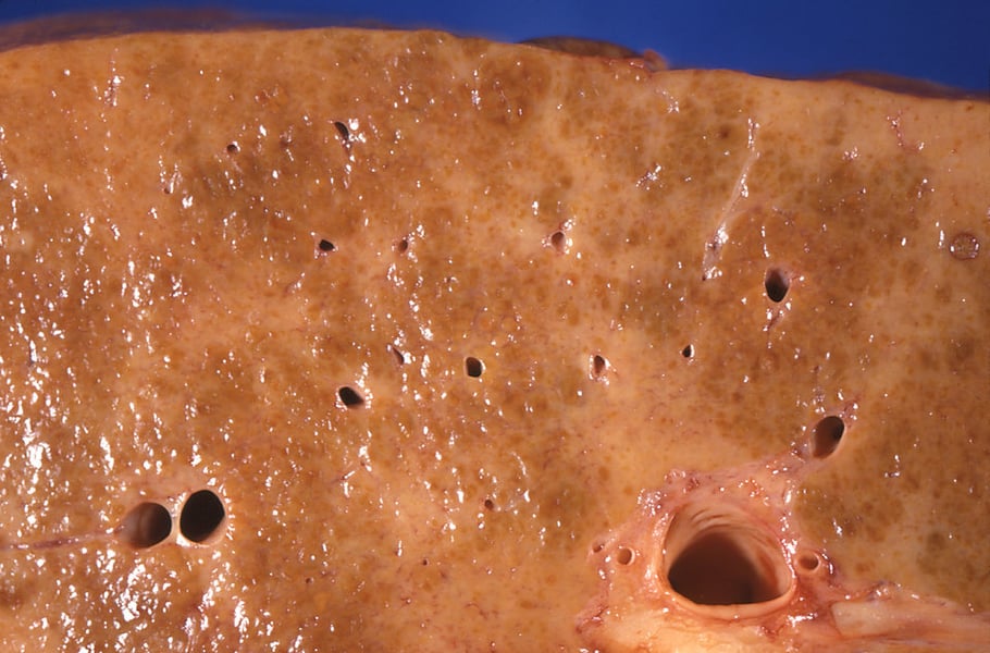 Gross pathology specimen of a liver with alcoholic cirrhosis showing fibrotic nodular changes from long-term alcohol damage