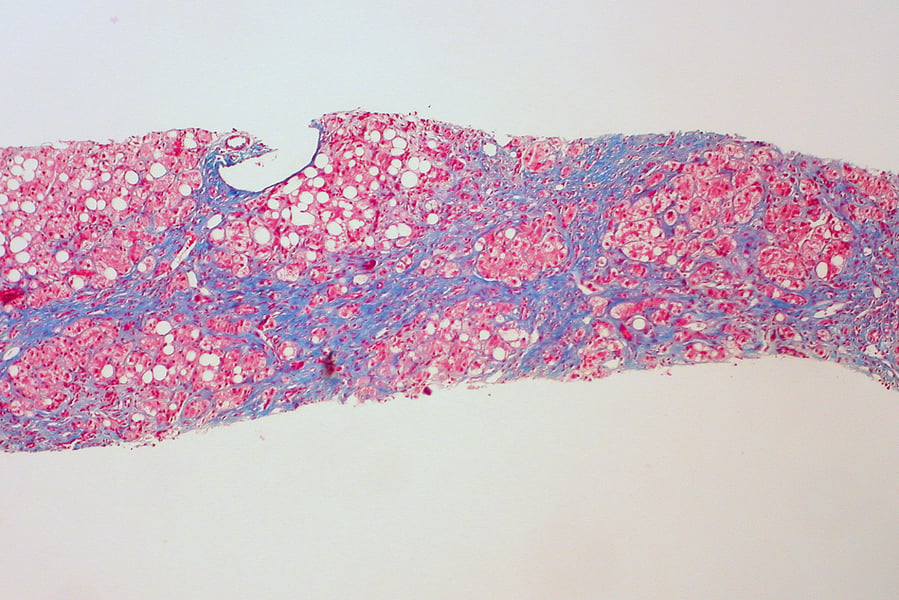 Cross-section of a liver affected by alcoholic cirrhosis showing structural damage from chronic alcohol use