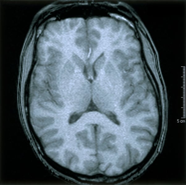 Axial MRI scan showing normal human brain cortex structure