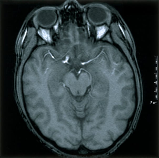 Normal brain axial MRI scan showing cortical structure relevant to Alzheimer's detection research