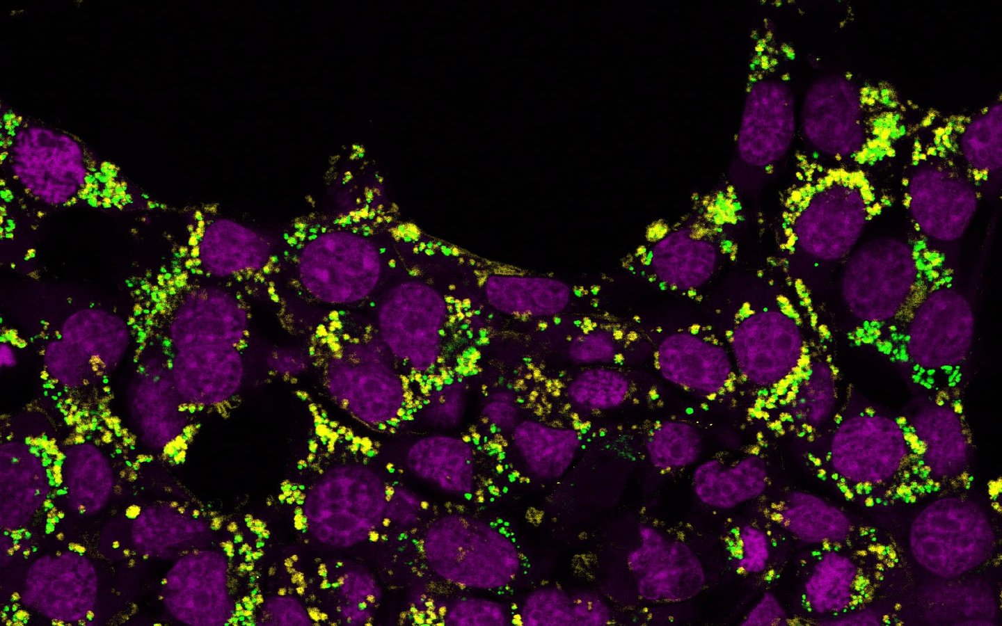 Laboratory image of breast cancer tissue from the Weizmann Institute study examining how sildenafil disrupts cancer cell cholesterol trafficking