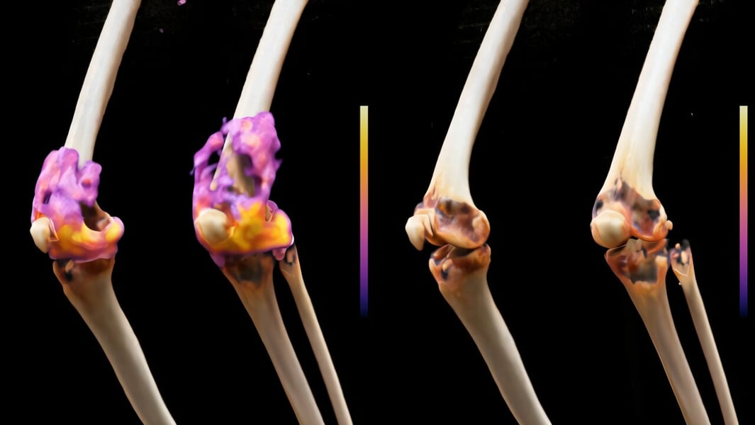 CAR T-cell therapy for rheumatoid arthritis treatment at Charité Berlin