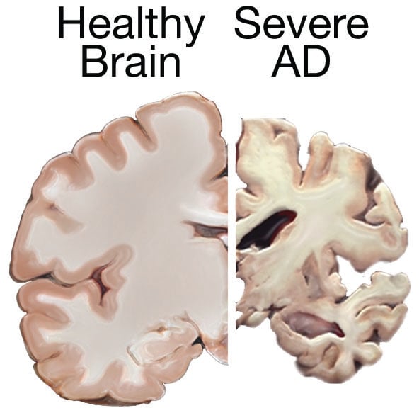 Side-by-side comparison of a healthy human brain and a brain with severe Alzheimer's disease showing atrophy