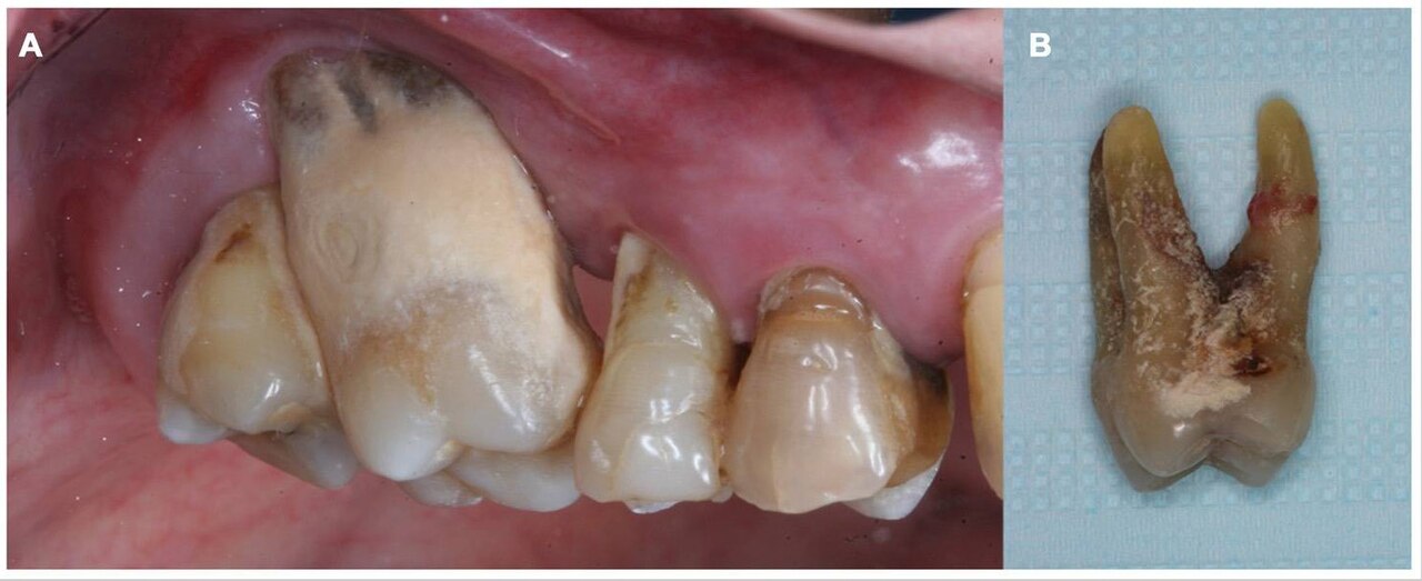 Close-up of severe periodontitis showing inflamed gum tissue and bone loss around teeth