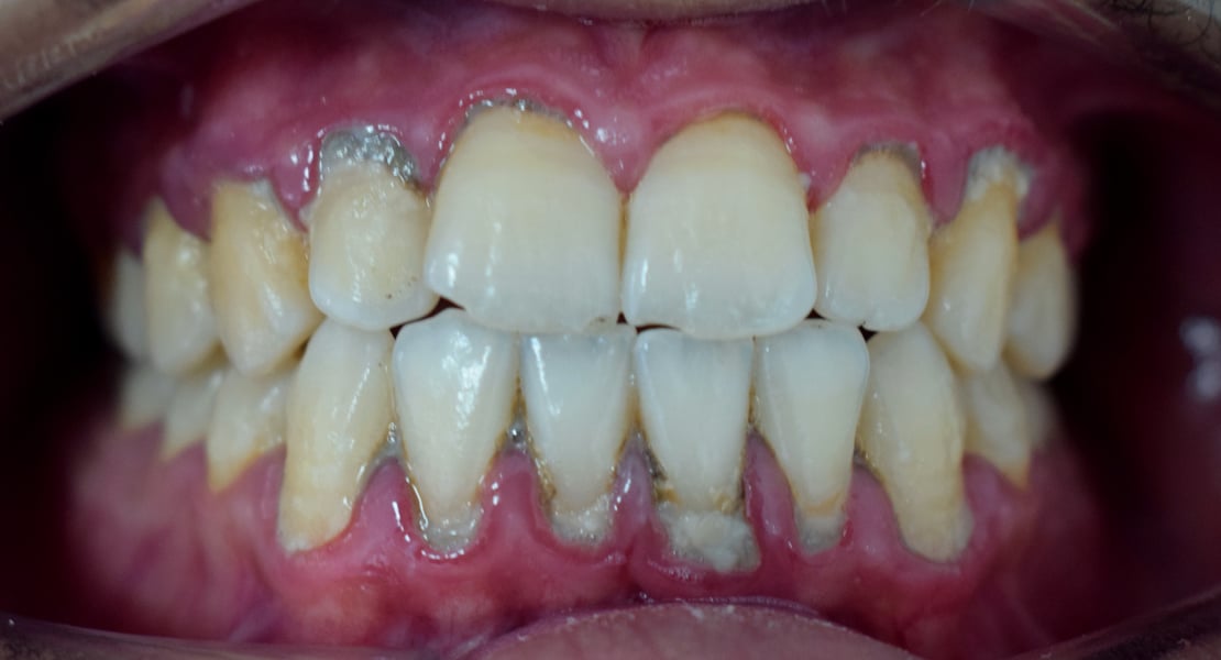 Dental plaque on teeth causing periodontitis