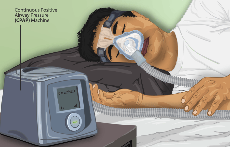 Illustration of a sleep apnea patient using a CPAP machine at night showing airway pressure therapy before oral pill alternative AD109