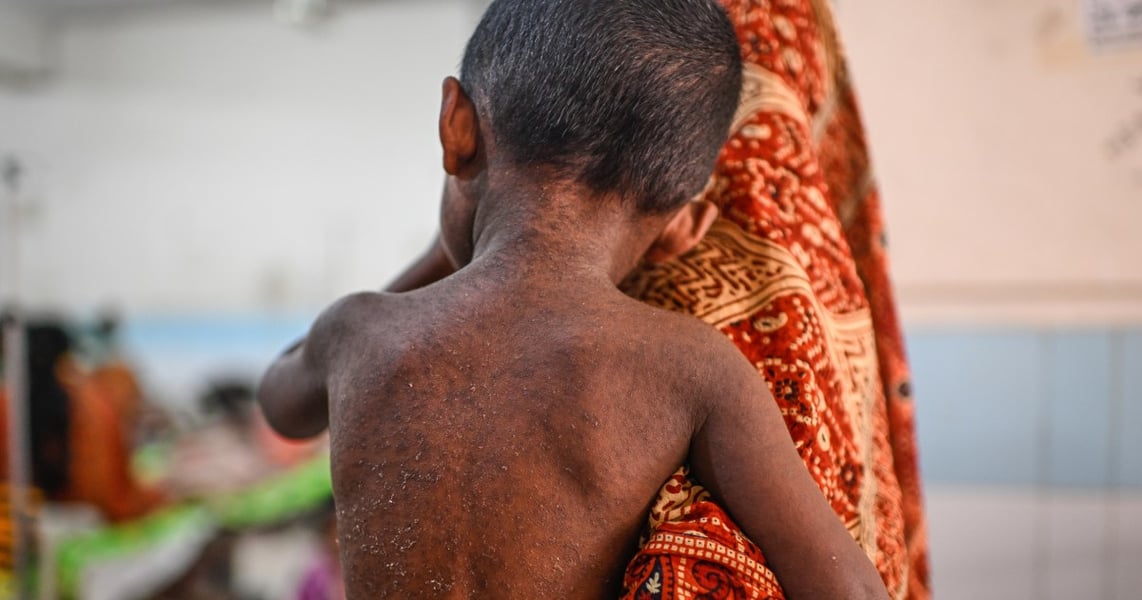 A child sick with measles receives treatment at a hospital in Dhaka, Bangladesh, during the 2026 outbreak