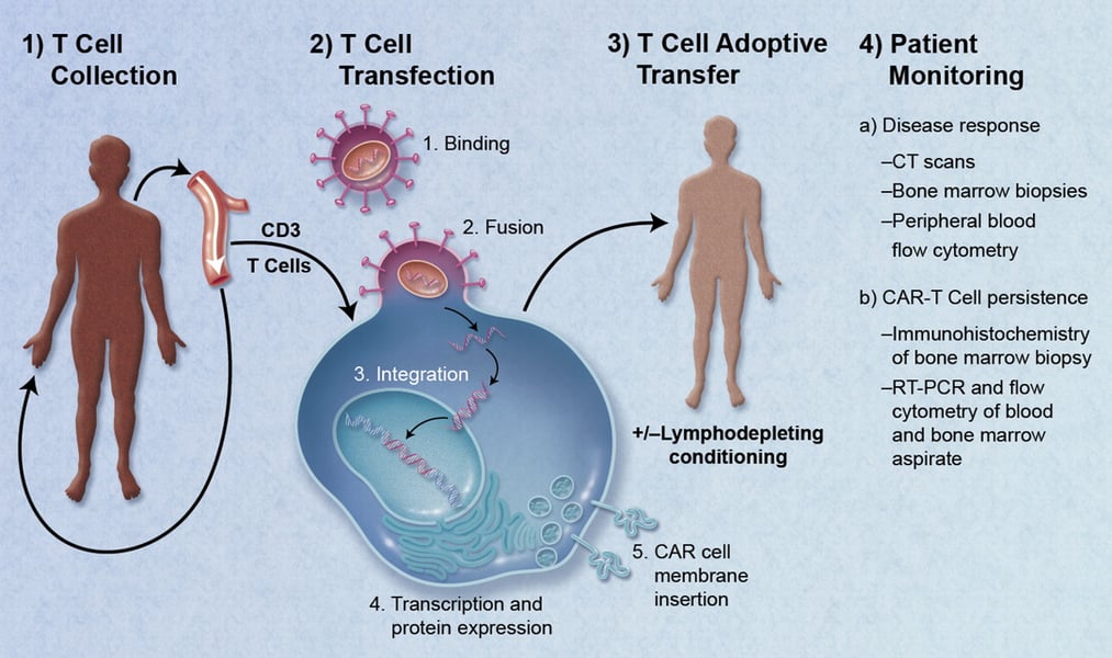 Diagram showing CAR T cell adoptive transfer process used in rheumatoid arthritis immunotherapy trial