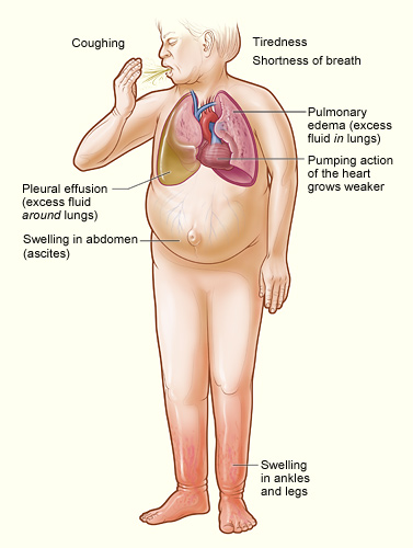 Medical illustration showing the major signs and symptoms of heart failure, as studied in relation to long-term melatonin use in the new TriNetX research