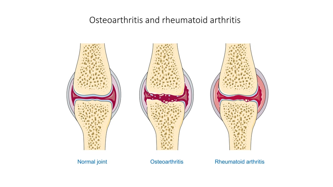Diagram comparing normal joint and osteoarthritis joint degeneration cartilage loss hydrogel treatment