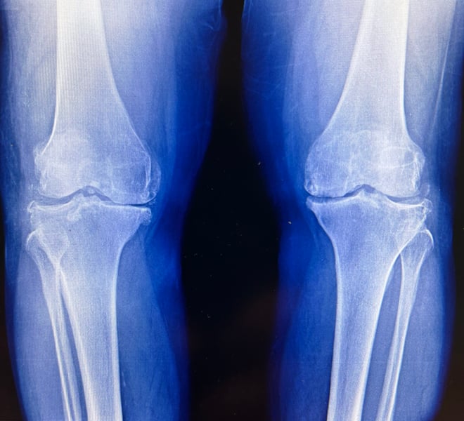 X-ray of knee joint affected by osteoarthritis showing varus deformity and joint space narrowing