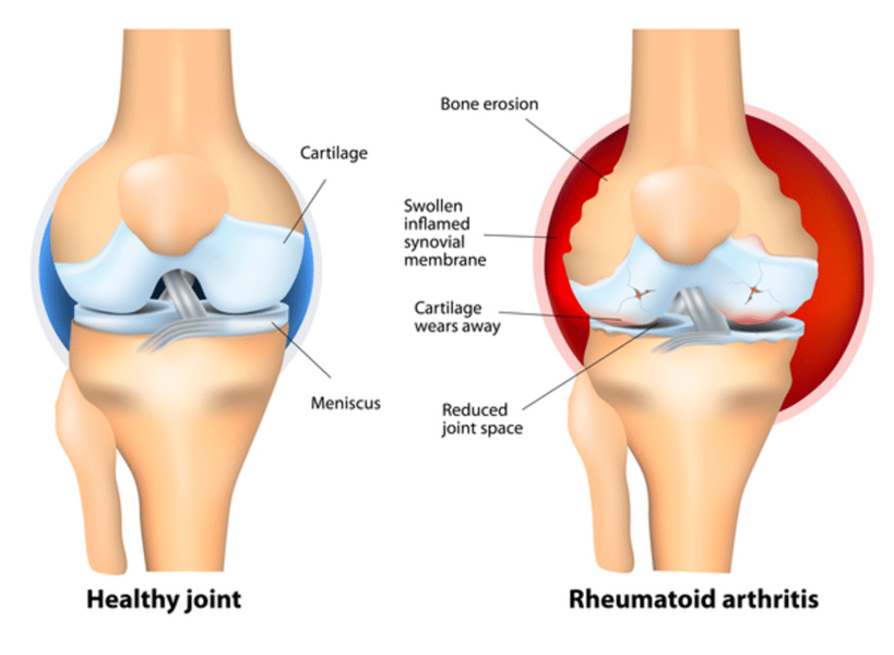 Illustration of rheumatoid arthritis showing inflamed joint with immune cell infiltration
