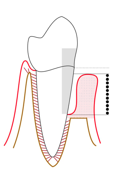 Clinical photograph of severe periodontitis showing gum recession and bone loss around teeth in a patient with Stage III or IV gum disease