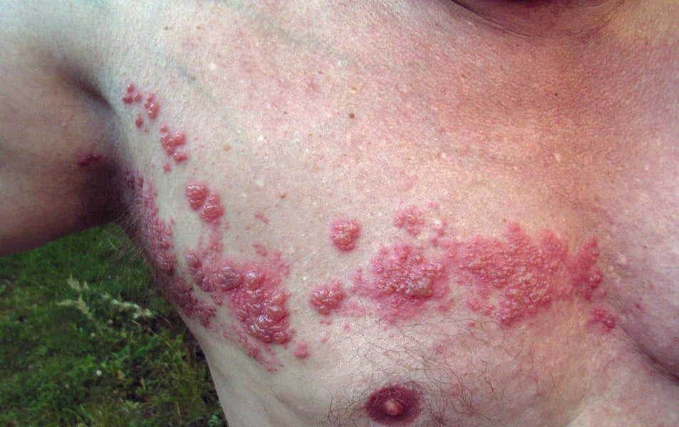 Herpes zoster shingles rash on the chest, the condition caused by varicella-zoster virus reactivation, linked by researchers to amyloid deposition and higher dementia risk in older adults