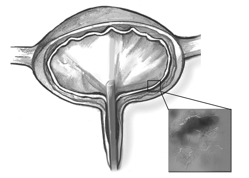 Drawing of a cystoscope inside the bladder with an inset showing a magnified section of the bladder wall